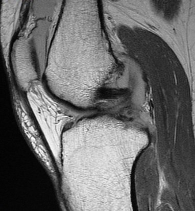 Figure 2 for case Meniscus tears ( RID2762 )